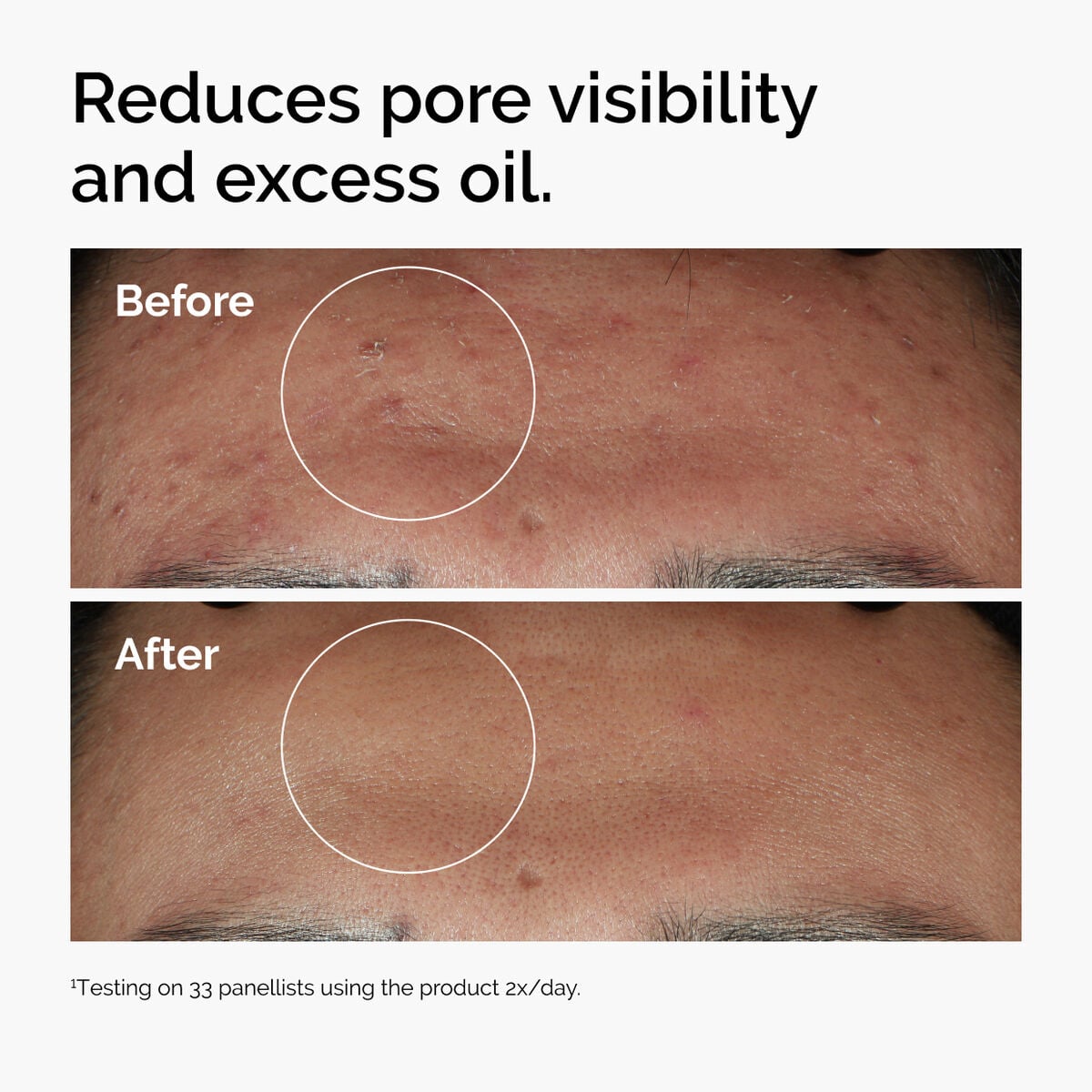 niacinamide-10-zinc-1-v2 ord-niacinamide-zinc-blemish-serum-before-after-pores.jpg