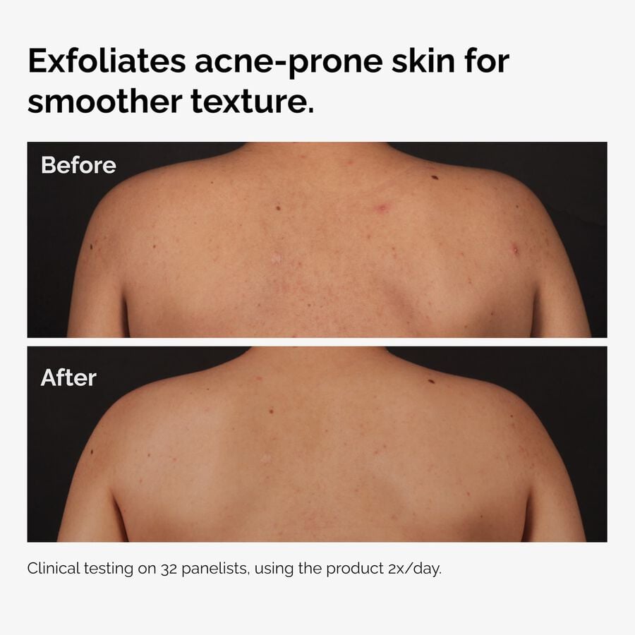 the-body-care-collection-g5 ord-salicylic-acid-body-serum-before-after-graphic-NA.jpg