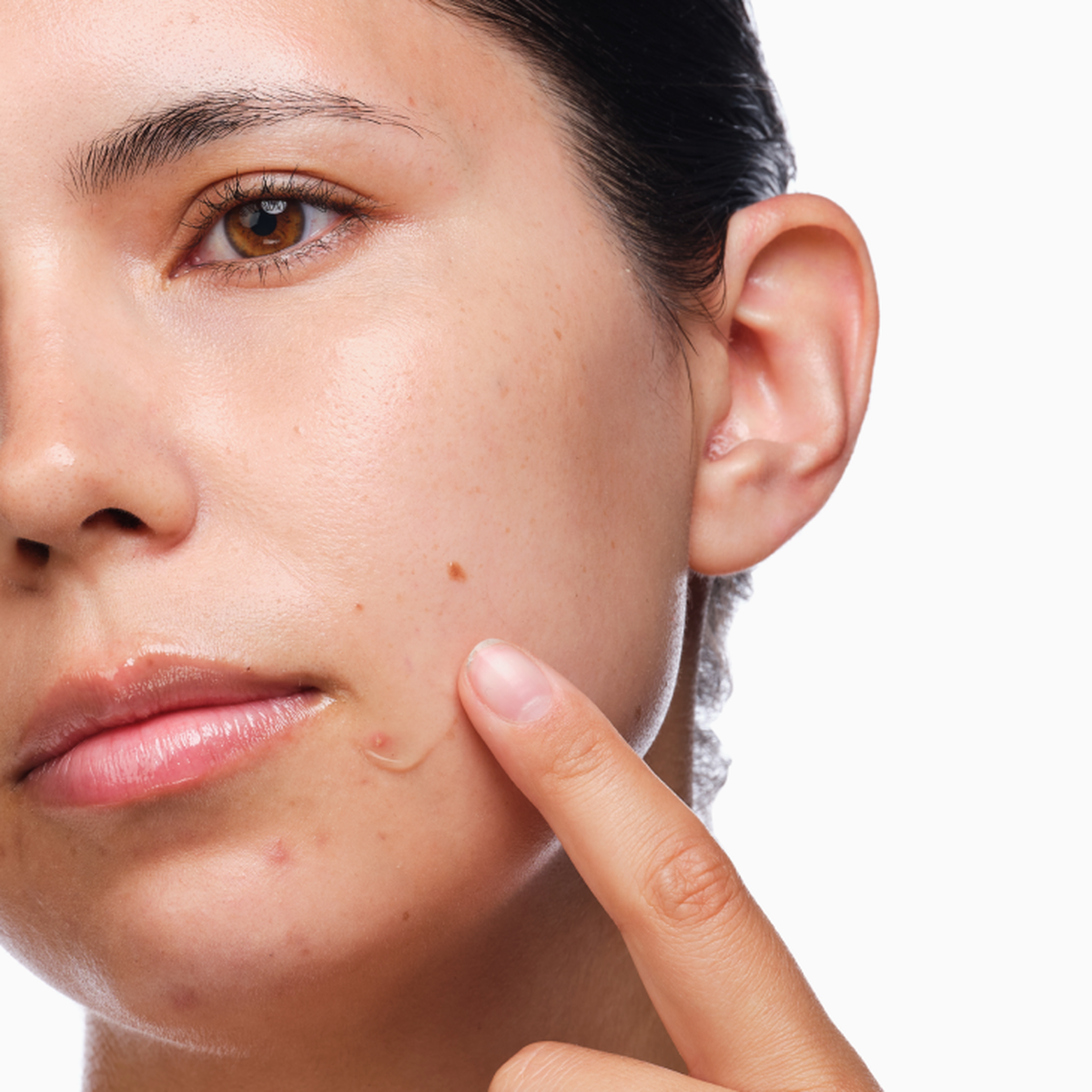 the-acne-set-j9 rdn-the-acne-set-application.png